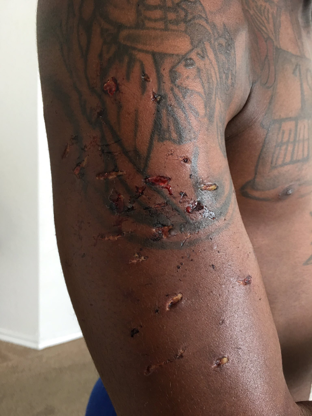 Photo showing what attorney Lee Merritt says are bite marks on Marlin Gipson’s arm (courtesy of Lee Merritt)
